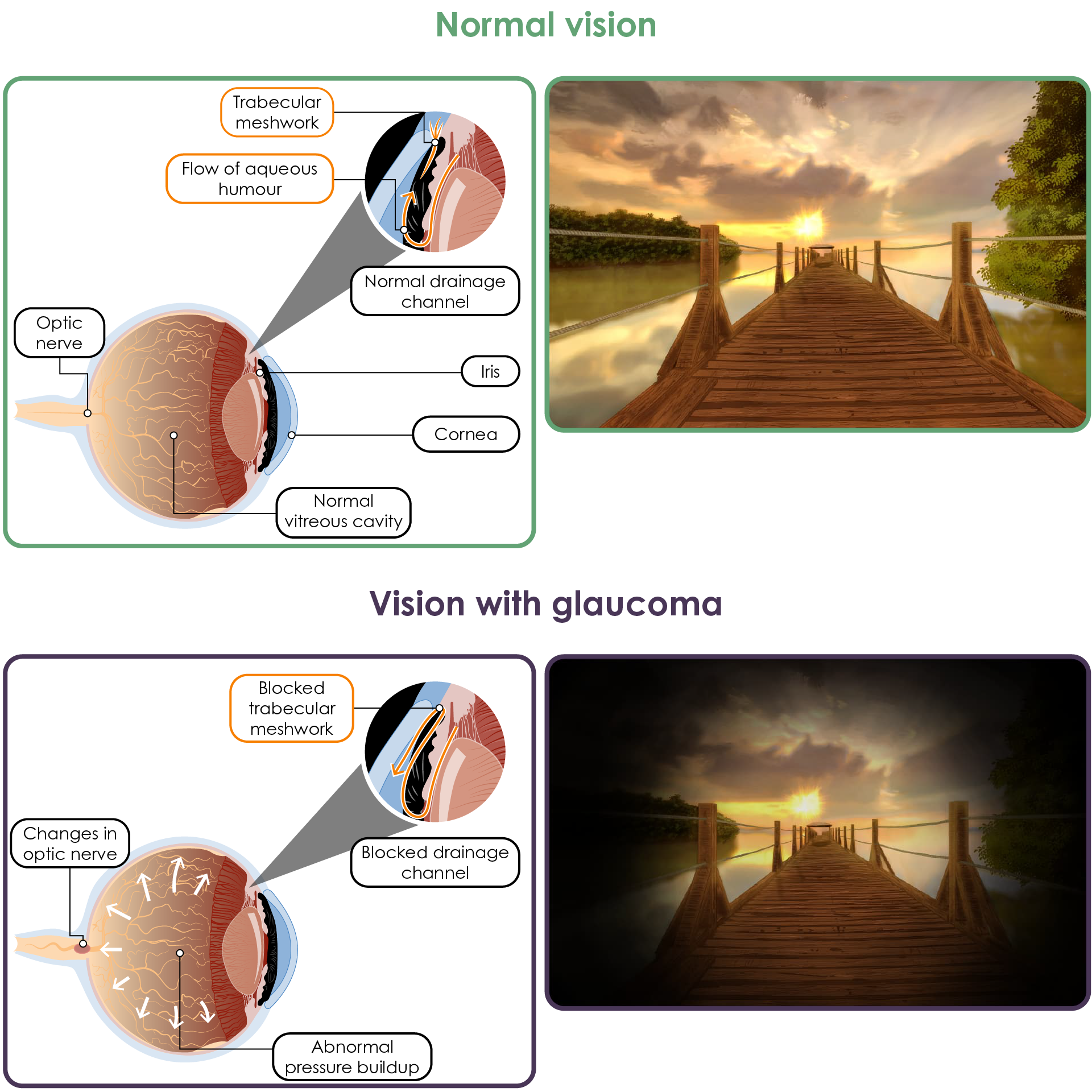 Open angle glaucoma and depiction of vision in normal versus glaucomatous vision